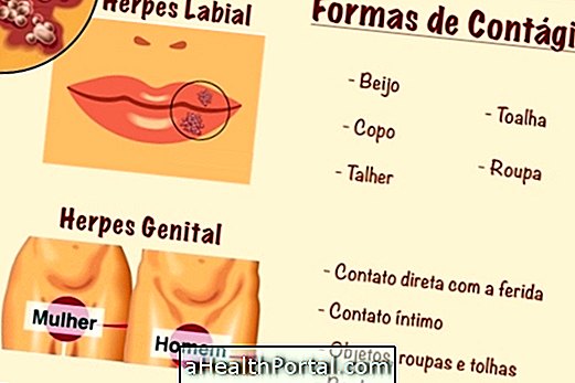 Suprasti, kodėl Herpes nėra išgydyti