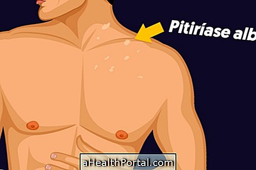 Τι είναι το Pityriasis alba και πώς να θεραπεύσει