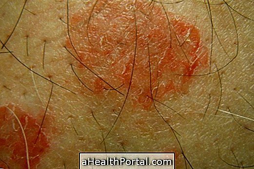 Apakah dermatitis nummular dan gejala utama