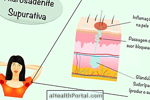 Inflamed lump in armpit or groin may not be tongue