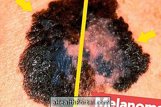 Hogyan lehet azonosítani a melanoma