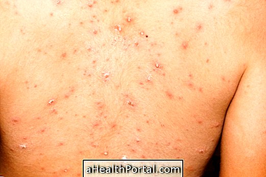 लिथियम pityriasis की पहचान और इलाज कैसे करें