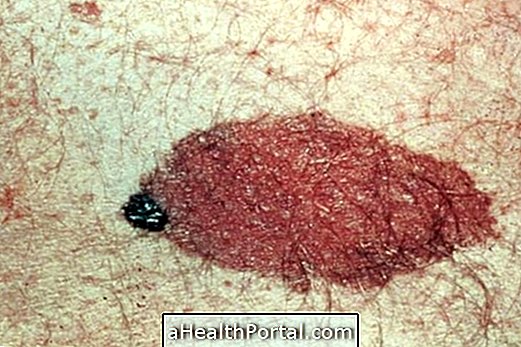 Melanoma คืออะไรและวิธีรักษามัน