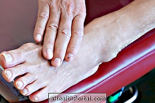 What is Peripheral Polyneuropathy and How to Treat It