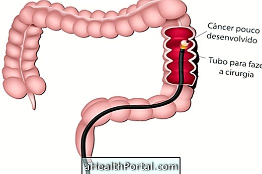 Comment se fait la chirurgie du cancer de l'intestin?