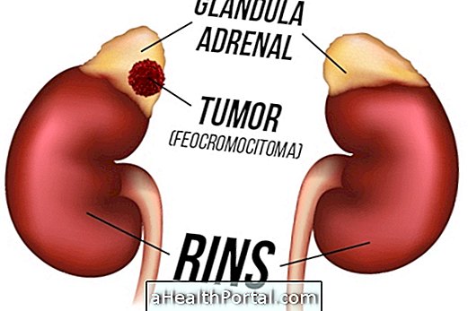 A pheochromocytoma azonosítása és kezelése