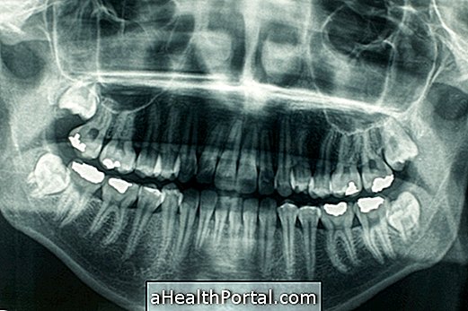 Memahami displasia cleidocranial