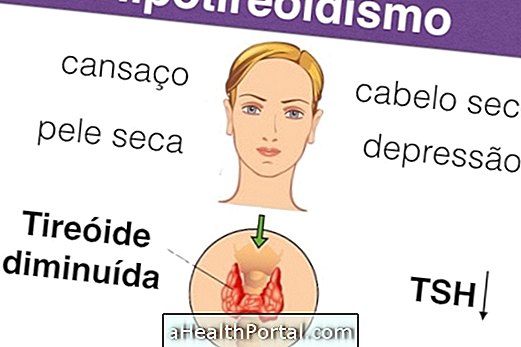 Hipotiroidizm Nasıl Tanımlanır ve Tedavi Edilir?