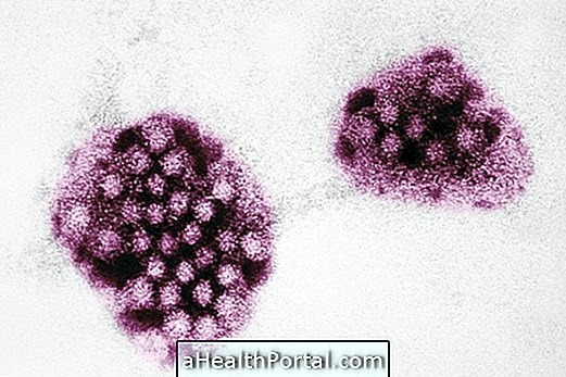 Norovirus: Τι είναι, συμπτώματα και θεραπεία