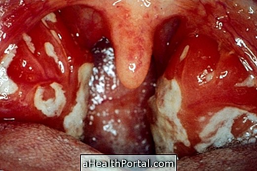 כיצד לזהות ולטפל Mononucleosis