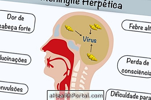 herpetic viral meningitis를 확인하고 치료하는 방법