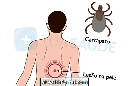 Lyme bệnh: Nó là gì và làm thế nào nó được thực hiện