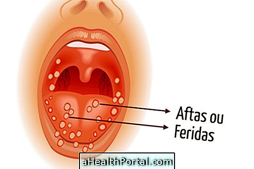 Memahami apabila virus Herpes menyebabkan luka kanker