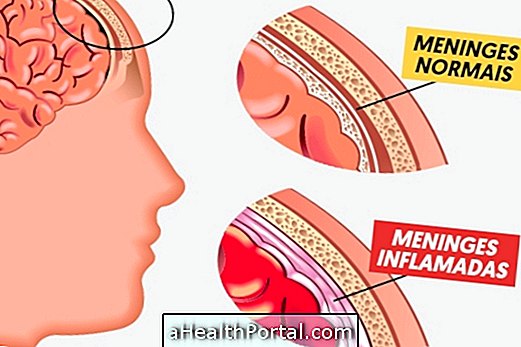 Meningokokus Meningitis