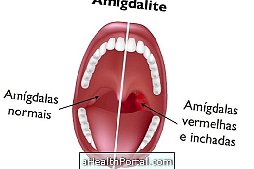 วิธีการระบุและรักษาอาการ Tonsillitis