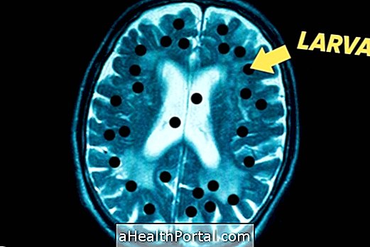 Cysticercosis là gì và cách xác định