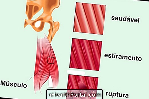 Làm thế nào để xác định và điều trị cơ bắp căng thẳng