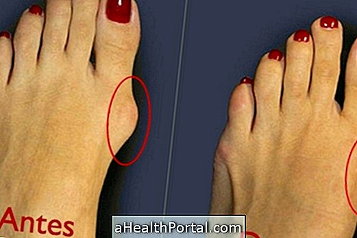 การผ่าตัดแบบ bunion ทำได้ดีเพียงใด?