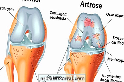 Adakah arthrosis menyembuhkan?