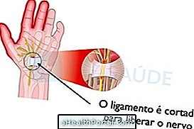 Tất cả về Carpal Tunnel Syndrome Surgery