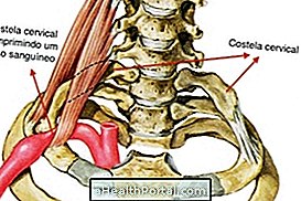 Các triệu chứng sườn cổ tử cung