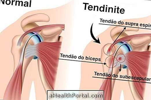 Behandlung von Tendonitis in der Schulter