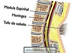 Verborgen spina bifida