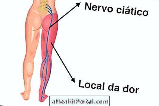 أعراض وعلاج العصب الوركي الملتهب