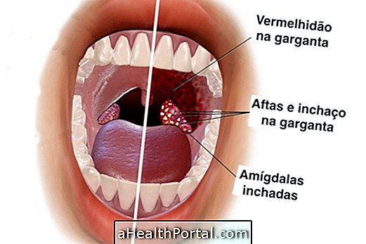 Mi a Vincent-angina és hogyan kezelik?