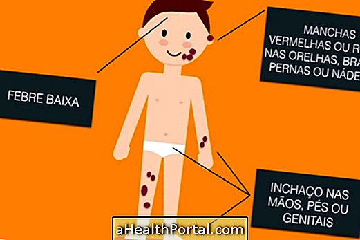 बचपन Urticaria Vasculitis की पहचान और इलाज कैसे करें