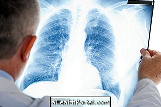 Apa itu Fibrosis Pulmonal dan Bagaimana Mengatasinya