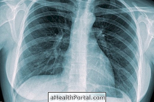 How is tuberculosis treated?