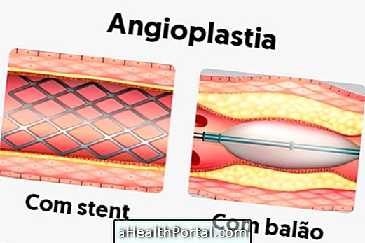 Kaj je angioplastika in kako je to storjeno?