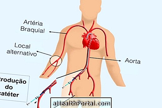 Tout ce que vous devez savoir sur le cathétérisme cardiaque