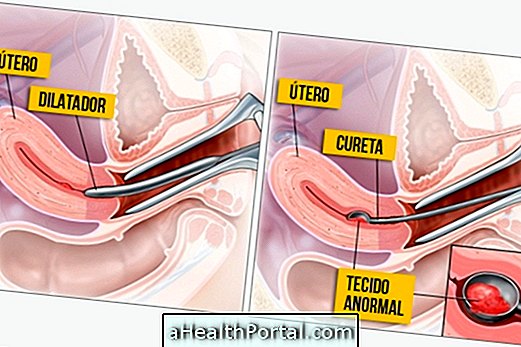 Kas yra Curettage ir kaip tai padaryti