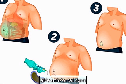 За какво е Paracentesis и за какво е това?