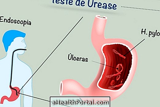 Kaip ureazės tyrimas nustato H. pylori