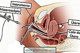 Mi a Hysteroscopy és mi az?