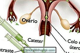 Hysterosalpingografi: En infertilitetsundersökning