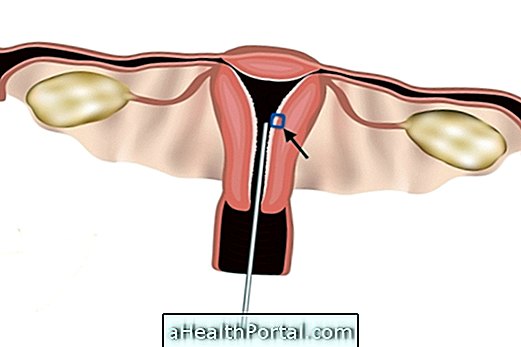 Nasıl yapıldığını ve Uterin Biyopsisinin sonucunu nasıl anlayacağınızı öğrenin