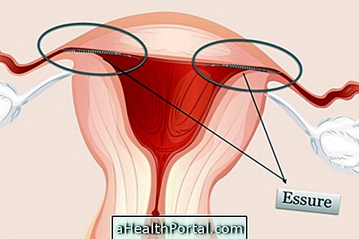 Κύριες παρενέργειες της Ultimate Αντίσταση Essure