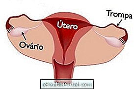 L'inflammation dans les trompes de Fallope peut rendre la grossesse difficile, mais guérit