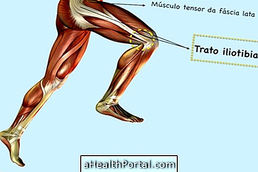 כיצד לרפא תסמונת הלהקה Iliotibial