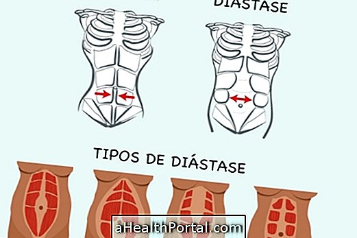 Cum să identificați și să tratați distopția abdominală