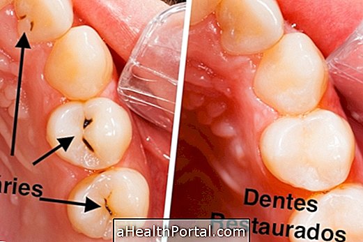 Comment identifier et traiter les caries dentaires