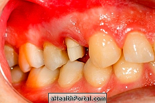 Treatment for swollen gums