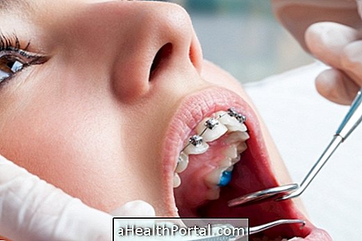 Jenis malocclusion pergigian dan bagaimana untuk merawat