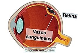 Kako se liječi retinopatija u ranijoj dobi