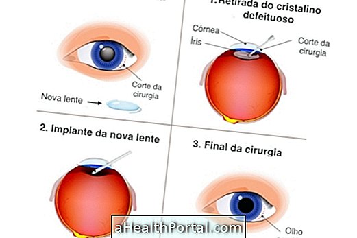 Phẫu thuật đục thủy tinh thể