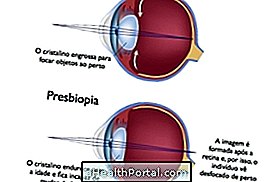 Các triệu chứng của viễn thị